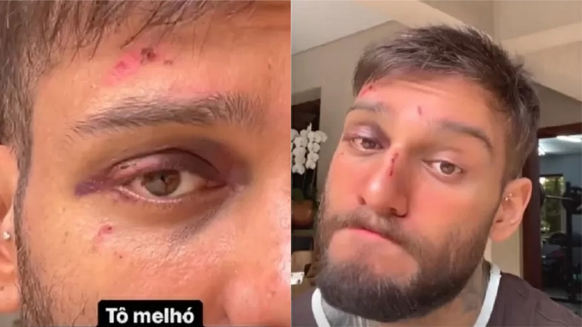 Lucas Lucco mostrou o rosto machucado (Foto: Reprodução/Instagram)
