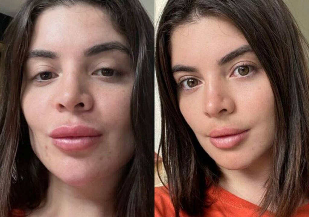 Gkay mostra antes e depois de remover preenchimento labial