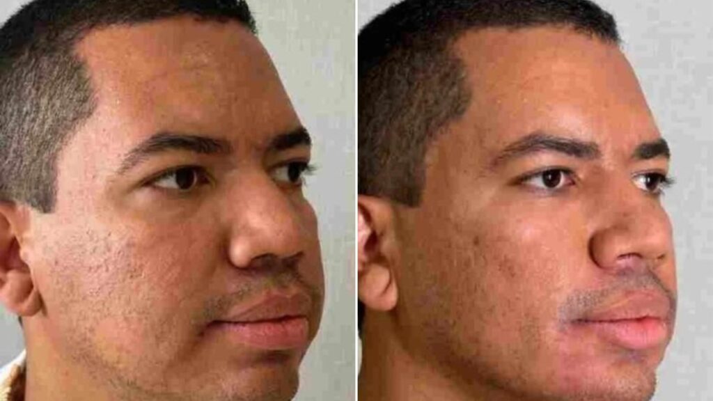 Bruno Gaga rebate críticas após realizar harmonização facial Bruno Gaga