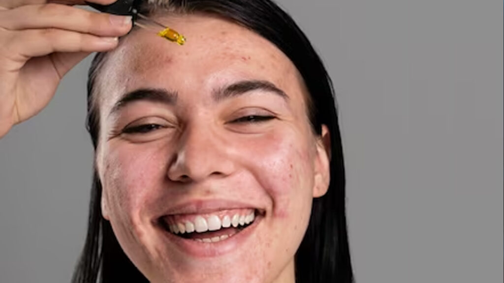Pele oleosa