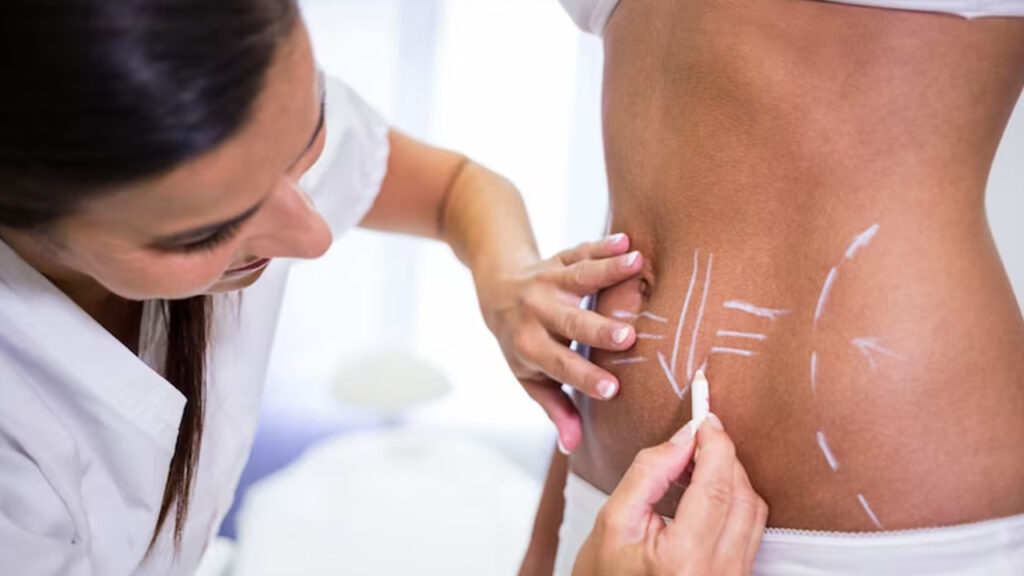 Lipoaspiração abdominoplastia