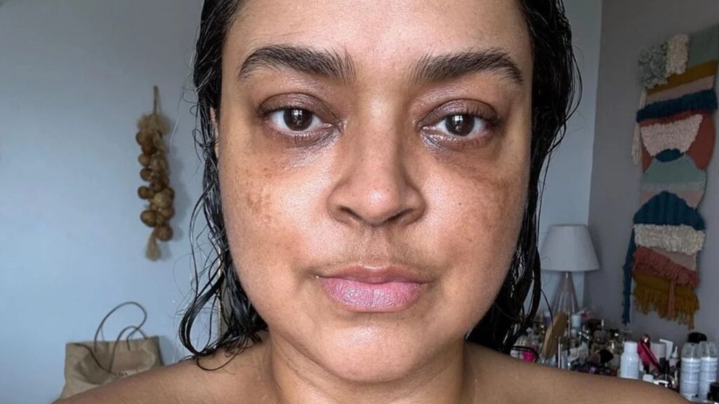 Preta Gil fala sobre a perda de cabelo no tratamento de câncer pretagil
