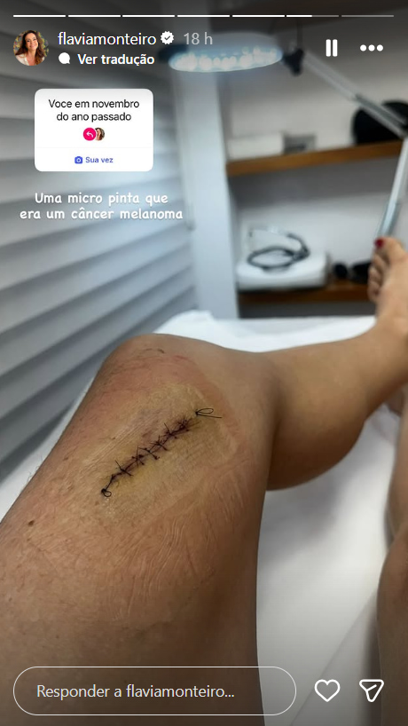 Flávia Monteiro alerta fãs após diagnóstico de câncer: 'uma micropinta' 1 Flávia Monteiro exibe cicatriz na perna após cirurgia para retirada de melanoma