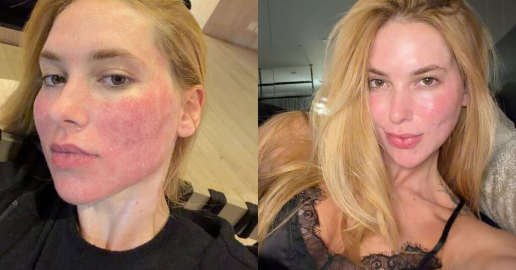Montagem com Virginia Fonseca mostrando forte vermelhidão no rosto após o laser, seguida de foto com máscara calmante e outra imagem deitada exibindo a pele sensibilizada.