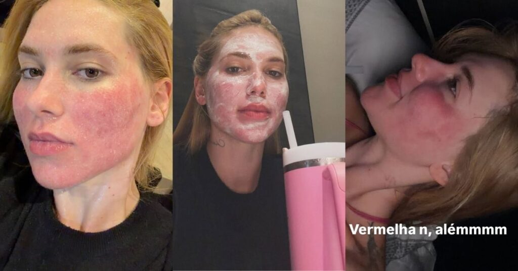 Montagem comparativa de Virginia Fonseca exibindo a pele ainda vermelha após o laser e outra foto com o rosto mais uniforme e luminoso horas depois.