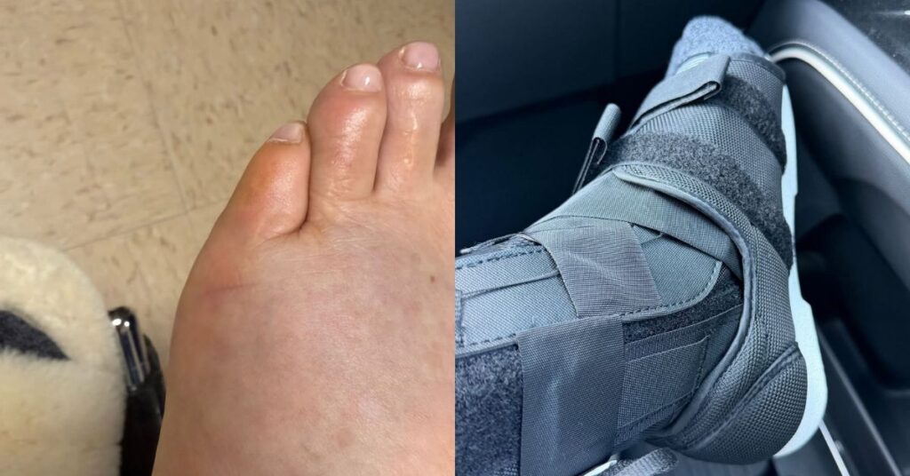 Zilu Camargo é levada ao hospital após acidente doméstico 1 Pé de Zilu Camargo inchado e com hematomas após acidente doméstico, ao lado de registro do pé imobilizado com bota ortopédica durante atendimento médico