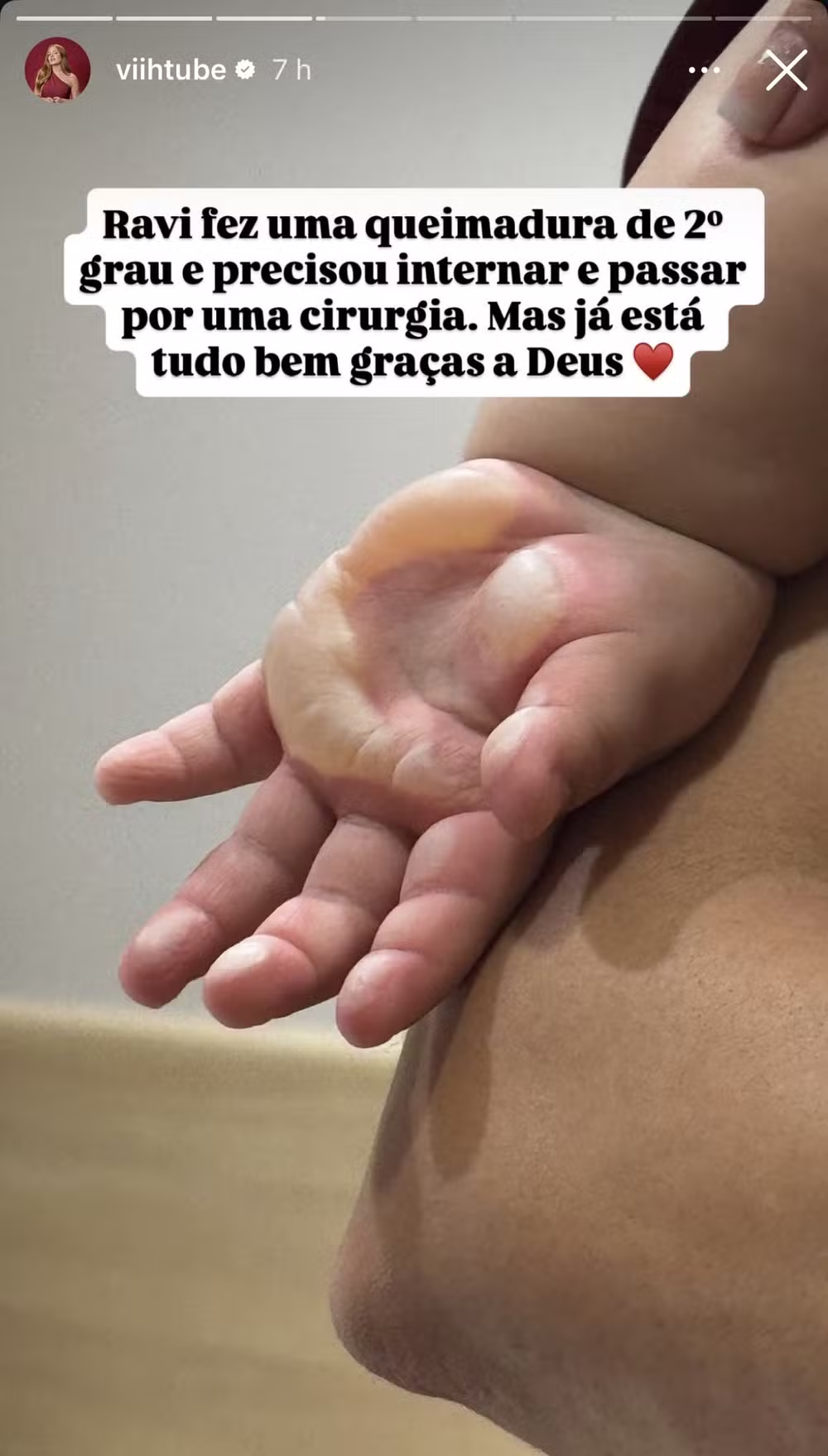 Imagens fortes! Filho de Viih Tube sofre queimadura grave e passa por cirurgia