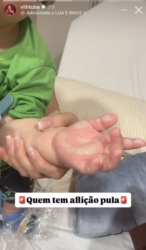 Filho de Viih Tube e Eliezer sofre queimadura grave e passa por cirurgia 2 Imagens fortes! Filho de Viih Tube sofre queimadura grave e passa por cirurgia