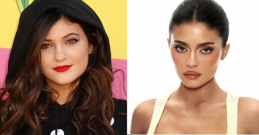 Antes e depois das celebridades: 15 transformações que chocaram 6 antes e depois das celebridades mostrando a transformação estética de Kylie Jenner