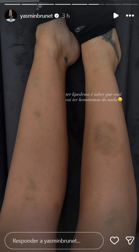 Yasmin Brunet preocupa ao surgir com hematomas e desbafa sobre lipedema: 'dia normal' 1 Pernas de Yasmin Brunet com hematomas visíveis em postagem sobre sintomas frequentes relacionados ao lipedema.