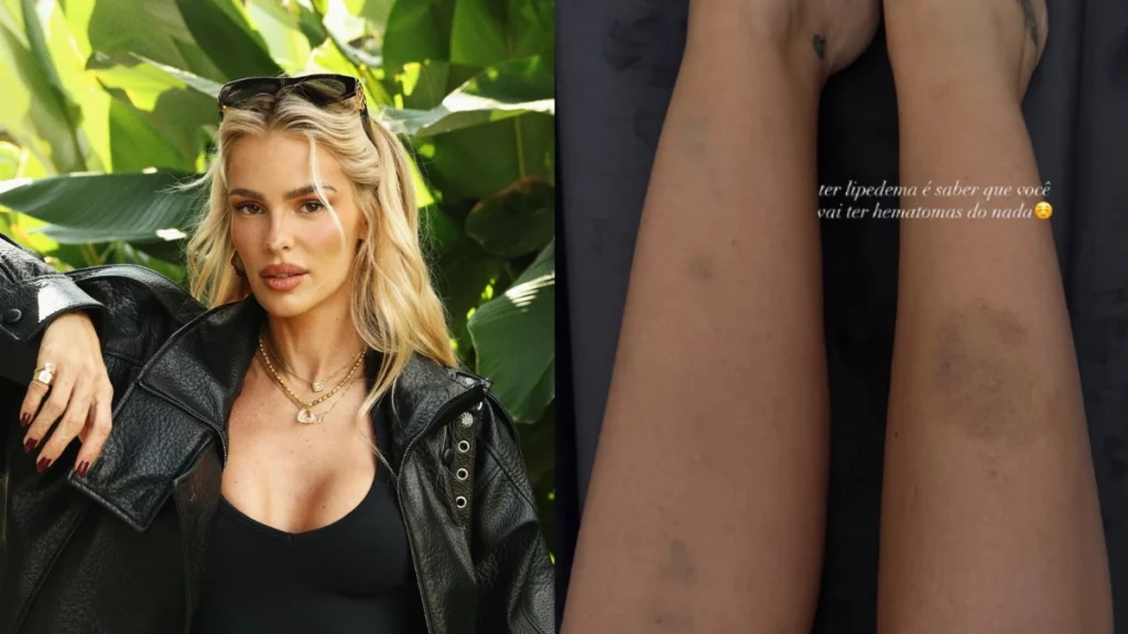 Yasmin Brunet preocupa ao surgir com hematomas e desbafa sobre lipedema: ‘dia normal’ Montagem mostra Yasmin Brunet, mulher loira de jaqueta preta, ao lado de pernas com hematomas associados ao lipedema.