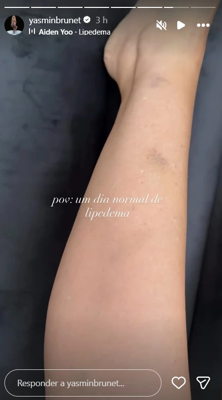 Yasmin Brunet preocupa ao surgir com hematomas e desbafa sobre lipedema: 'dia normal' 2 Yasmin Brunet com hematomas visíveis em publicação sobre rotina de quem convive com lipedema.