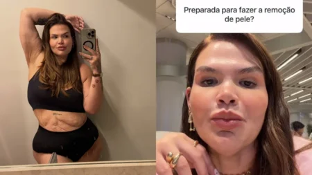 Thais Carla aparece em duas fotos: à esquerda, posa diante do espelho mostrando o corpo após o emagrecimento; à direita, responde sobre a remoção de pele.