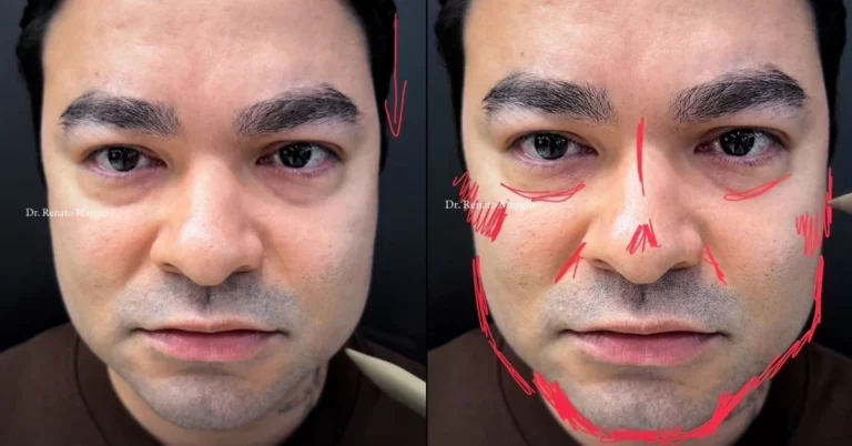 Yudi Tamashiro faz harmonização aos 34 anos; veja antes e depois Yudi Tamashiro aparece em registros do processo de harmonização facial, com marcações feitas no rosto